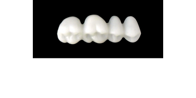 Cod.S1UPPER RIGHT : 15x  posterior solid (not hollow) wax bridges, LARGE , (14-17) , with precarved occlusion to Cod.S1LOWER RIGHT,and compatible to Cod.E1UPPER RIGHT (hollow), (14-17)